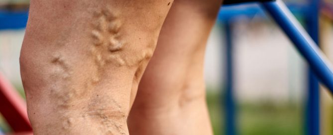 Severe Varicose Veins
