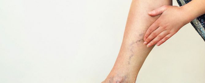 home remedies veins