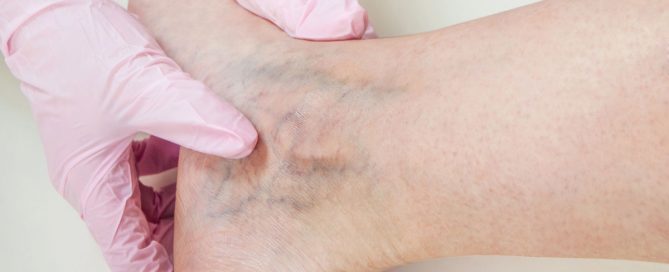 Signs of Vein Disease