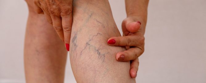 Do Spider Veins Go Away