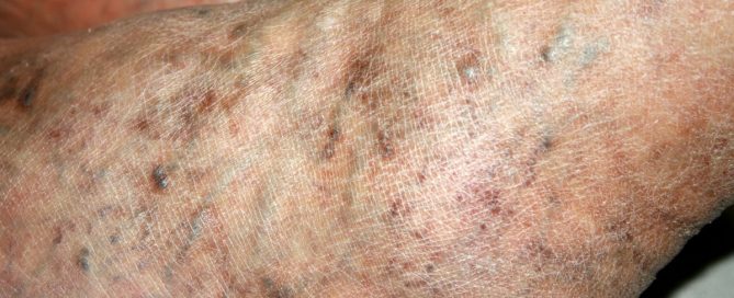 Chronic Venous Hypertension