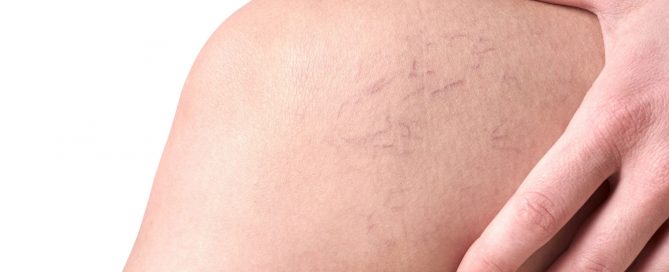 Risks of Untreated Spider Veins