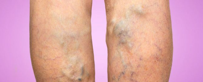 Hereditary Varicose Veins