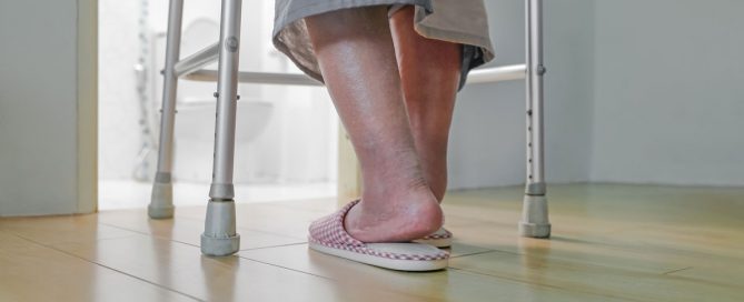 Edema Vein disease