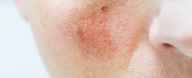 Causes of Broken Capillaries