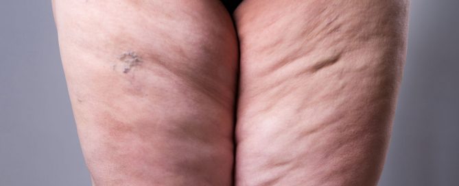 The Effects of Weight on Your Veins