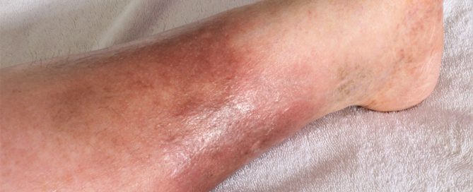 popped vein