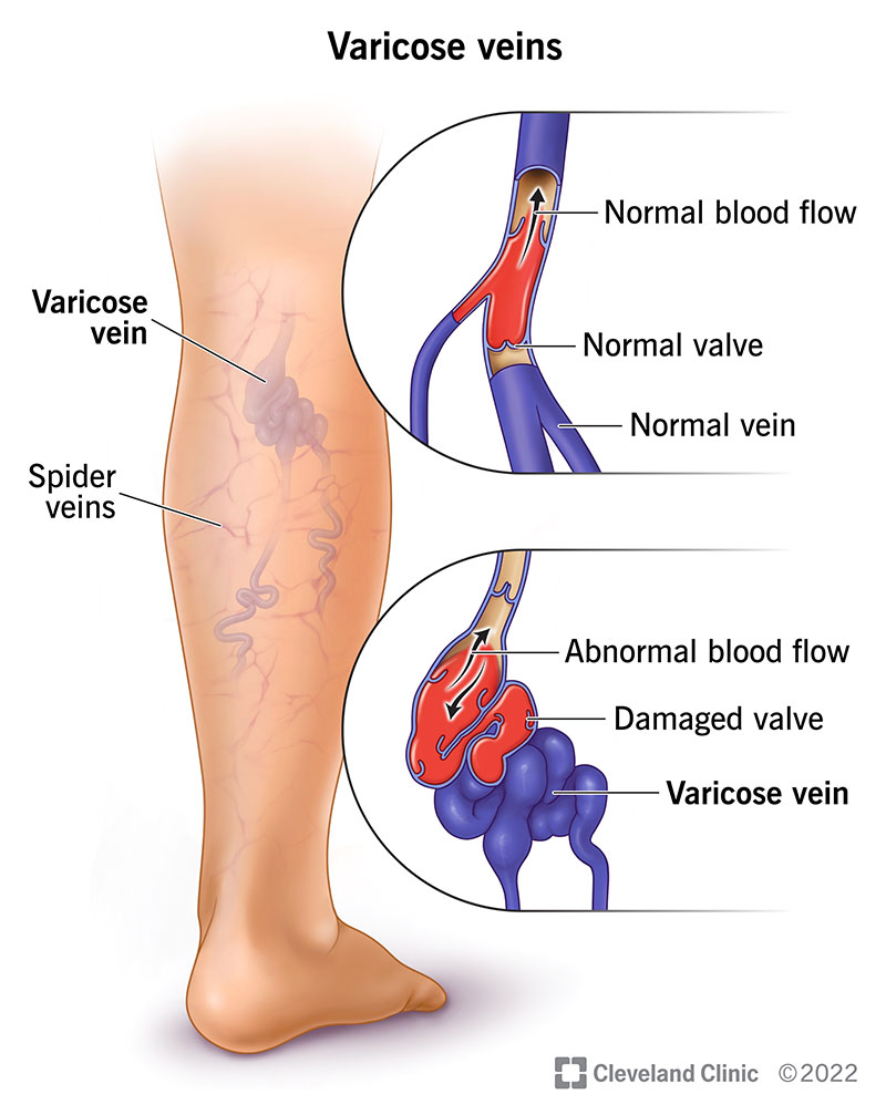 varicose-veins