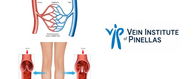 Vein Health